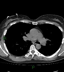 File:Aortic valve endocarditis (Radiopaedia 87209-103485 Axial non-contrast 45).jpg