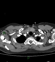 Aortic valve endocarditis (Radiopaedia 87209-103485 C 10).jpg