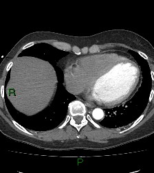 Aortic valve endocarditis (Radiopaedia 87209-103485 C 68).jpg
