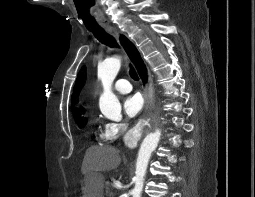 Aortoesophageal fistula with endovascular repair (Radiopaedia 73781-84592 Sagittal C+ CTPA 103).jpg