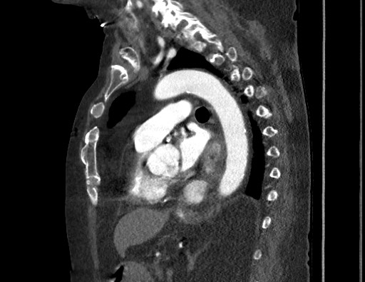 Aortoesophageal fistula with endovascular repair (Radiopaedia 73781-84592 Sagittal C+ CTPA 115).jpg