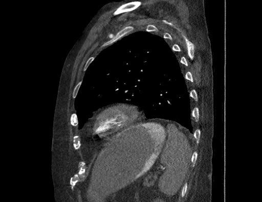 File:Aortoesophageal fistula with endovascular repair (Radiopaedia 73781-84592 Sagittal C+ CTPA 156).jpg