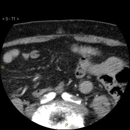 Aortoiliac occlusive disease (Radiopaedia 16828-16548 A 71).jpg