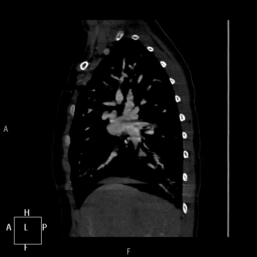 File:Aortopulmonary septal defect (Radiopaedia 41990-45013 Sagittal C+ CTPA 45).jpg