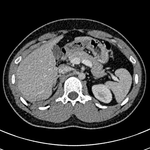 Apical lung mass mimic - neurogenic tumor (Radiopaedia 59918-67521 A 87).jpg