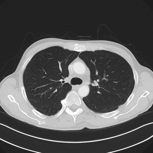Apical pleural calcification (Radiopaedia 46141-50499 Axial lung window 24).png
