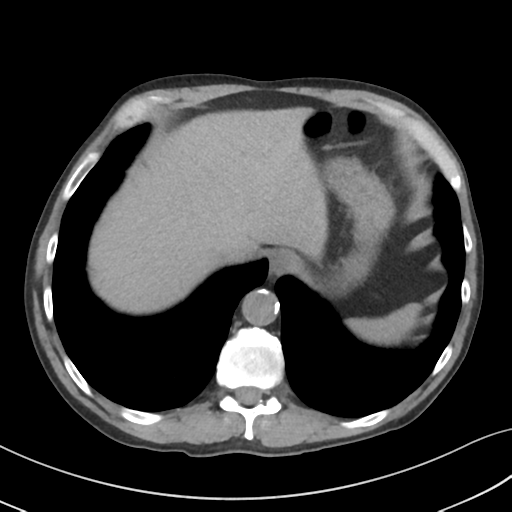 File:Apical pulmonary metastasis (Radiopaedia 46338-50754 B 54).png