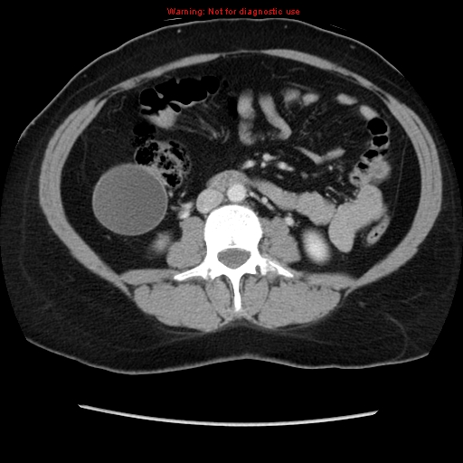 Appendiceal mucinous cystadenoma (Radiopaedia 8263-9111 Axial liver window 43).jpg