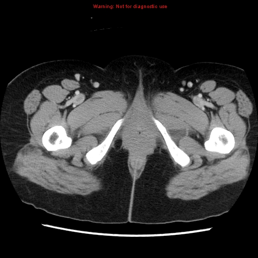 Appendiceal mucinous cystadenoma (Radiopaedia 8263-9111 Axial liver window 87).jpg