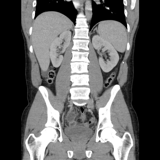 Appendicitis complicated by post-operative collection (Radiopaedia 35595-37114 B 35).jpg