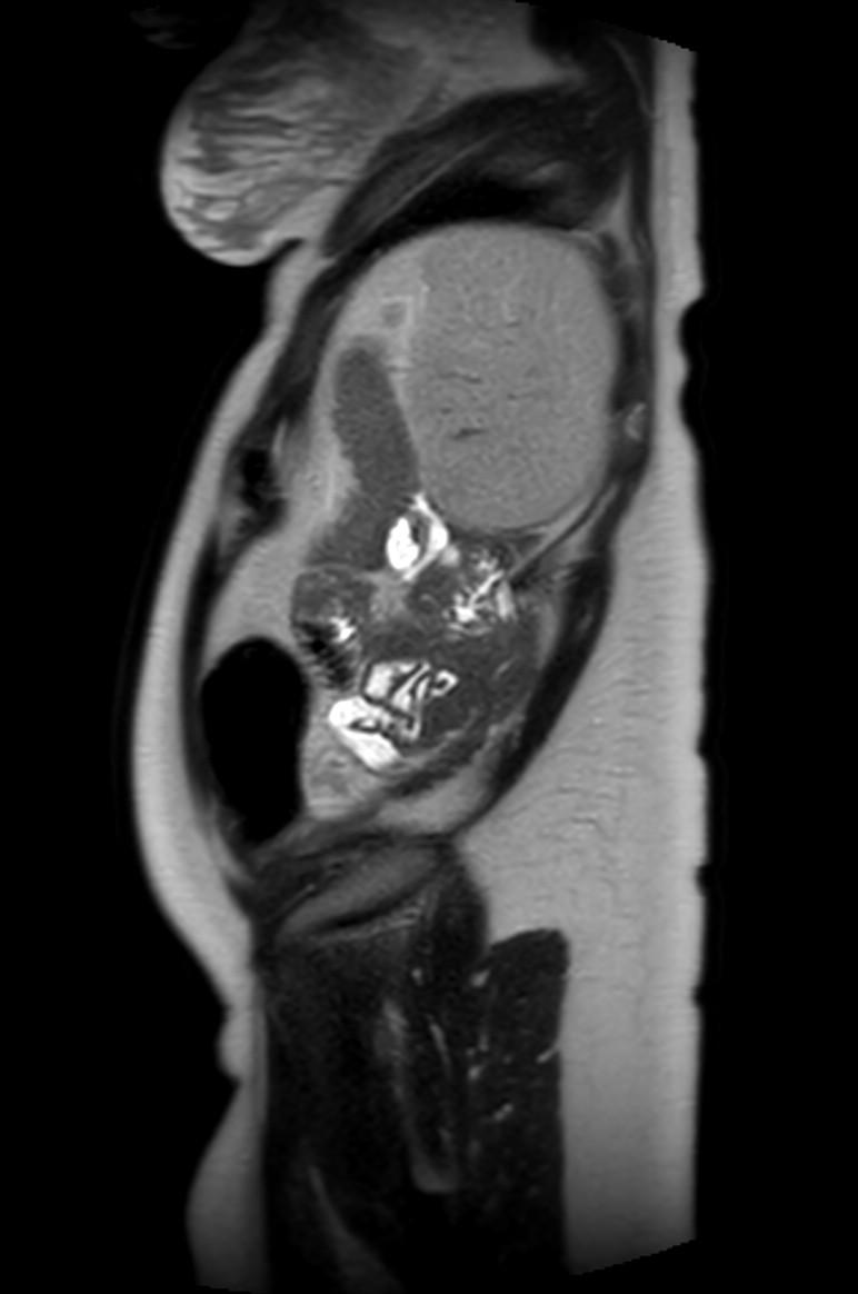 Appendicitis in gravida (MRI) (Radiopaedia 89433-106395 Sagittal T2 10).jpg
