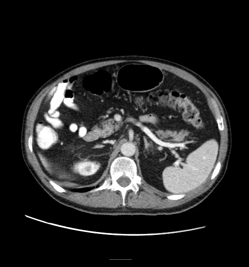 Appendicitis with localized perforation and abscess formation (Radiopaedia 49035-54130 A 32).jpg