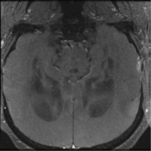 Aqueduct stenosis with corpus callosum hypoattenuation post shunting (Radiopaedia 37212-38969 Axial CSF Flow 40).png