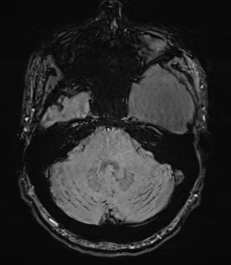 Arachnoid cyst with subdural hematoma (Radiopaedia 85892-101743 Axial SWI 19).png