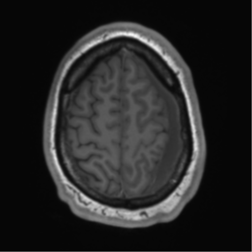 File:Arachnoid cyst with subdural hematoma (Radiopaedia 85892-101743 Axial T1 71).png