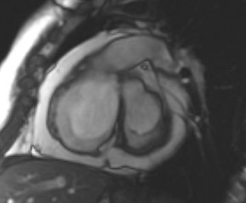 Arrhythmogenic right ventricular cardiomyopathy (Radiopaedia 69431-79307 Short axis cine 195).jpg