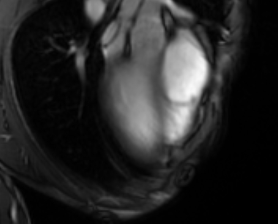 Arrhythmogenic right ventricular cardiomyopathy (Radiopaedia 69564-79464 4ch cine 1).jpg