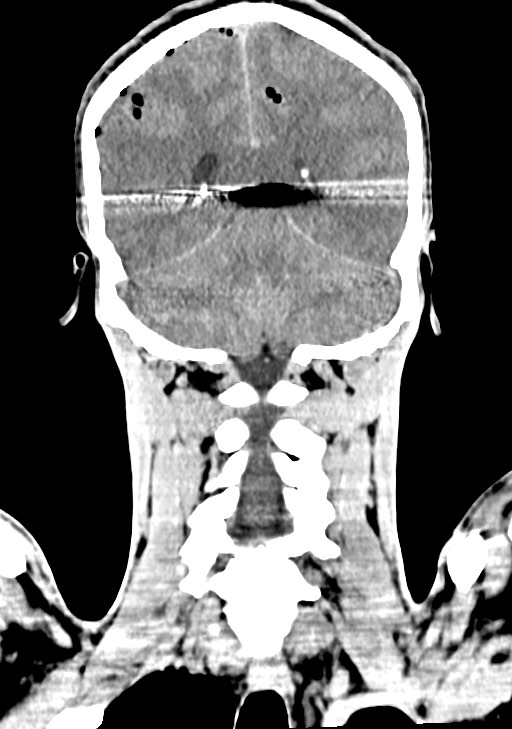Arrow injury to the brain (Radiopaedia 72101-82607 Coronal non-contrast 52).jpg