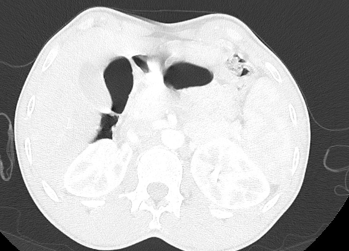 Arrow injury to the neck (Radiopaedia 75225-86323 Axial lung window 80).jpg