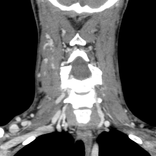 Arteriovenous malformation of the neck (Radiopaedia 53935-60062 D 18).jpg