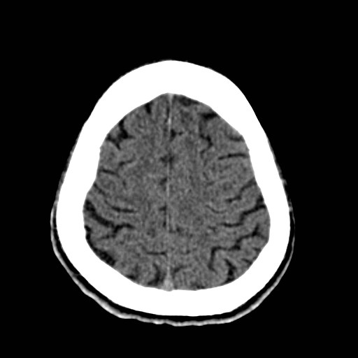 File:Artery of Percheron infarct (Radiopaedia 48088-52893 Axial non-contrast 32).jpg