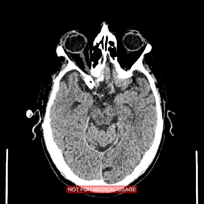 Artery of Percheron infarction (Radiopaedia 28679-28967 Axial non-contrast 45).jpg