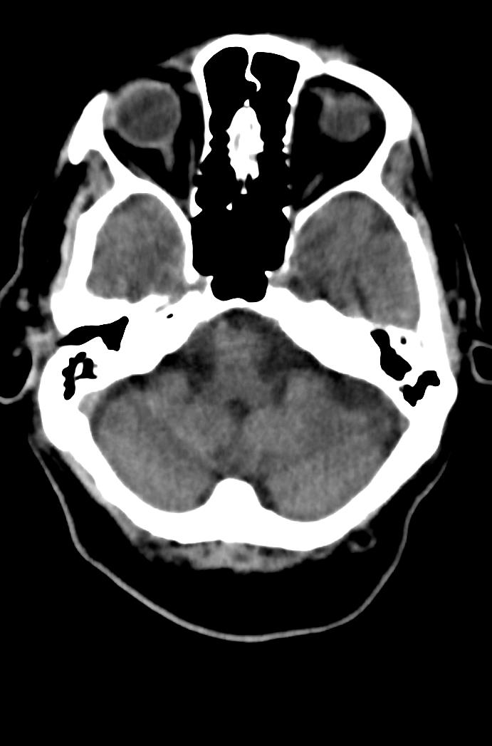 Artery of Percheron infarction (Radiopaedia 80613-94202 Axial non-contrast 50).jpg