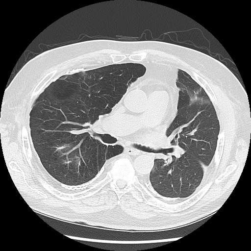 Asbestos-related pleural disease (Radiopaedia 74366-85250 Axial lung window 56).jpg