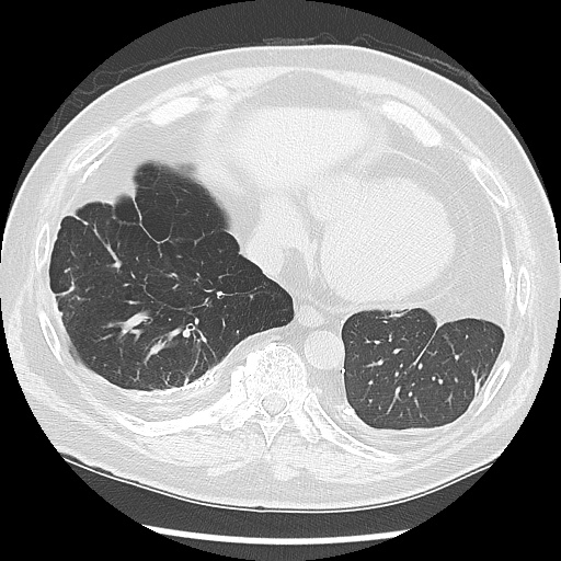 Asbestos-related pleural disease (Radiopaedia 74366-85250 Axial lung window 87).jpg