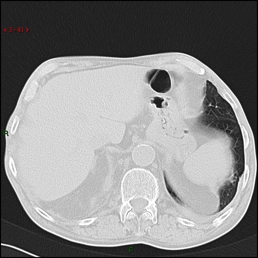 File:Aspergilloma (Radiopaedia 14842-14787 Axial lung window 41).jpg