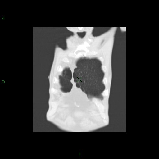 File:Aspergilloma (Radiopaedia 14842-14787 Coronal lung window 4).jpg
