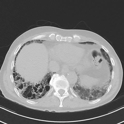 Aspergilloma on background pulmonary fibrosis (Radiopaedia 60942-68757 A 44).jpg