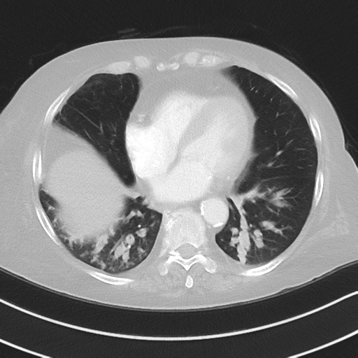 Aspiration bronchiolitis (Radiopaedia 53464-59463 Axial lung window 39).png