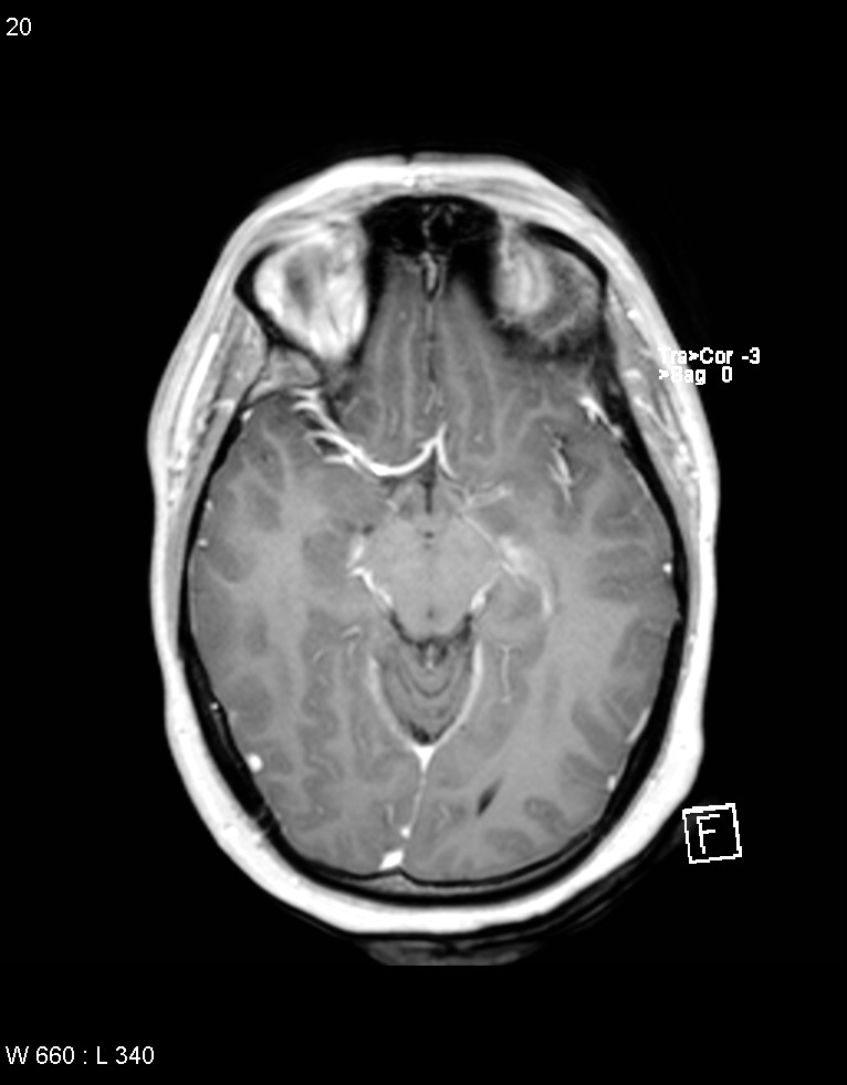 Astroblastoma (Radiopaedia 39792-42218 Axial T1 C+ 19).jpg