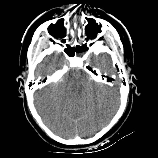 Atlanto-occipital dislocation (Radiopaedia 44648-48412 Axial non-contrast 18).jpg