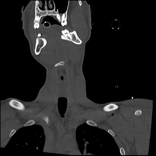Atlanto-occipital dissociation (Traynelis type 1), C2 teardrop fracture, C6-7 facet joint dislocation (Radiopaedia 87655-104061 Coronal bone window 16).jpg