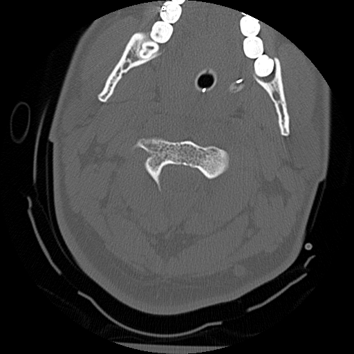 Atlanto-occipital dissociation injury (Radiopaedia 29274-29698 Axial bone window 21).png