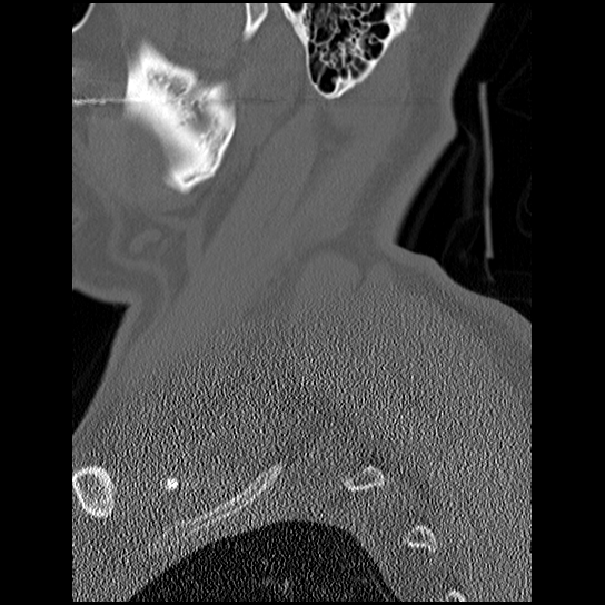 File:Atlanto-occipital dissociation injury (Radiopaedia 29274-29698 Sagittal bone window 2).png