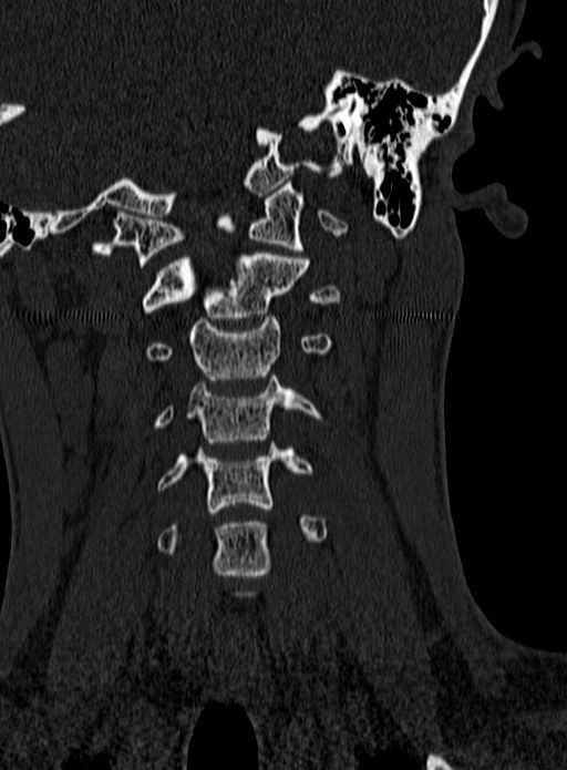 Atlantoaxial subluxation (Radiopaedia 44681-48450 Coronal bone window 43).jpg