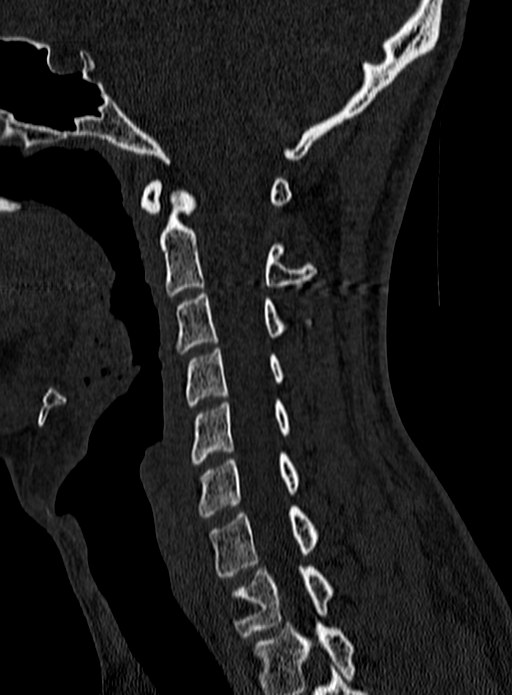Atlantoaxial subluxation (Radiopaedia 44681-48450 Sagittal bone window 59).jpg