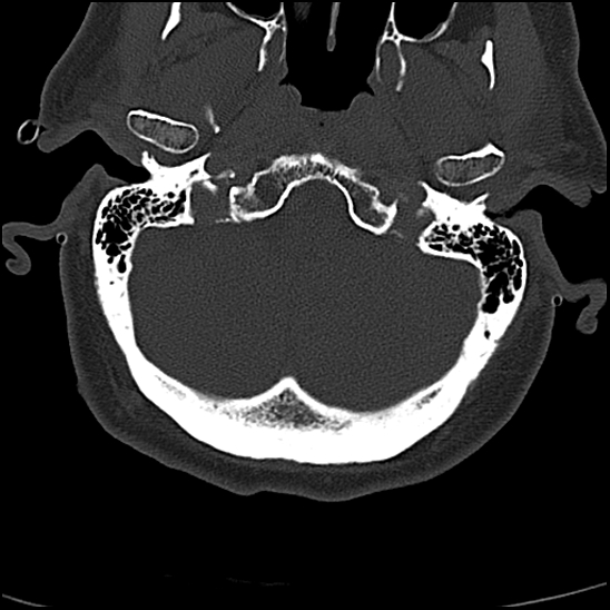File:Atlas (type 3b subtype 1) and axis (Anderson and D'Alonzo type 3, Roy-Camille type 2) fractures (Radiopaedia 88043-104607 Axial bone window 2).jpg