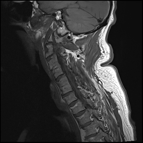 File:Atlas (type 3b subtype 1) and axis (Anderson and D'Alonzo type 3, Roy-Camille type 2) fractures (Radiopaedia 88043-104610 Sagittal T1 9).jpg