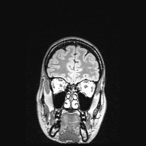 File:Atretic encephalocoele with inferior vermis hypoplasia (Radiopaedia 30443-31108 Coronal FLAIR 147).jpg