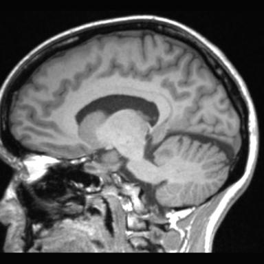 Atretic encephalocoele with inferior vermis hypoplasia (Radiopaedia 30443-31108 Sagittal T1 56).jpg