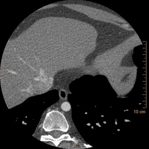 File:Atrial septal defect (upper sinus venosus type) with partial anomalous pulmonary venous return into superior vena cava (Radiopaedia 73228-83961 A 255).jpg