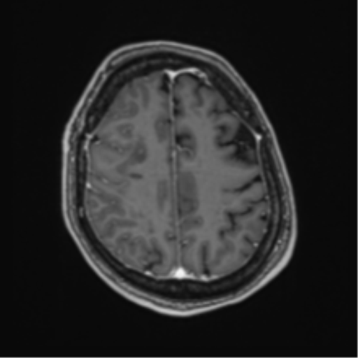 Atypical meningioma (WHO Grade II) (Radiopaedia 54742-60981 Axial T1 C+ 53).png