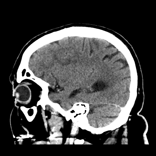 Atypical meningioma (WHO grade II) with brain invasion (Radiopaedia 57767-64728 Sagittal C+ 38).png