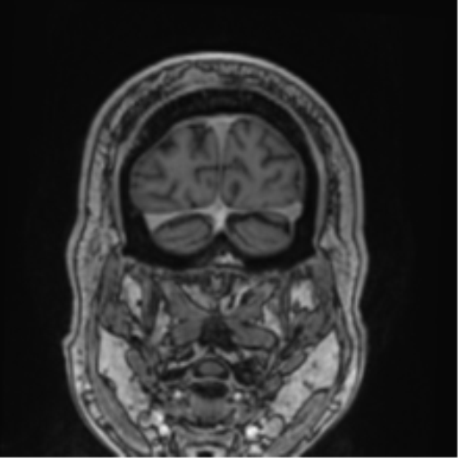 Atypical meningioma (WHO grade II) with brain invasion (Radiopaedia 57767-64729 Coronal T1 C+ 77).png
