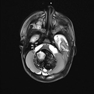 File:Atypical teratoid rhabdoid tumor (prenatal US and neonatal MRI) (Radiopaedia 59091-66388 Axial T2 9).jpg