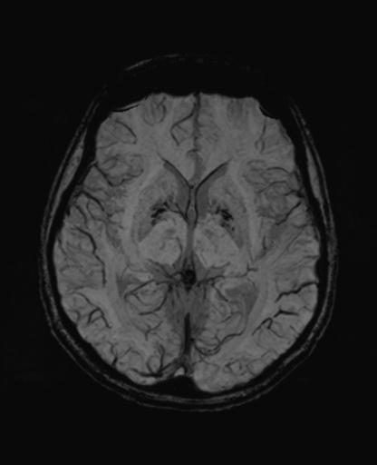 Autoimmune limbic encephalitis (Radiopaedia 30363-31005 SWI - mIP 35).jpg